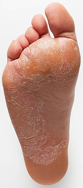 Horribly dry and infected man's foot.